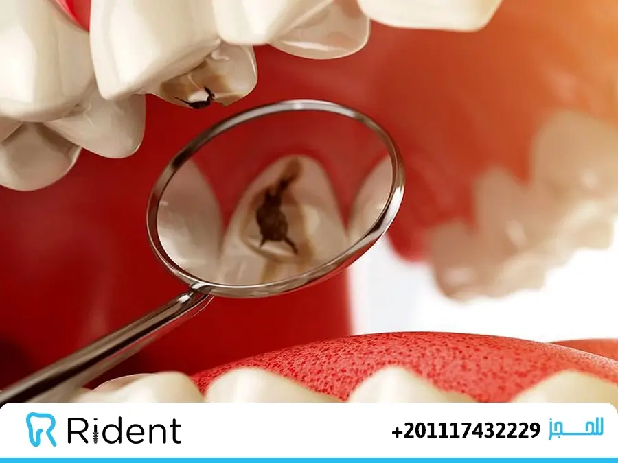 تسوس الاسنان