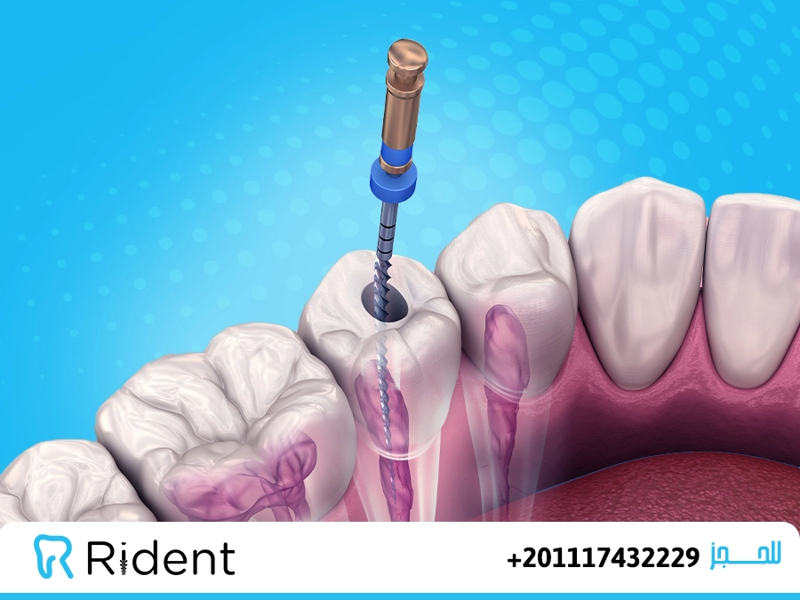 علاج عصب الاسنان