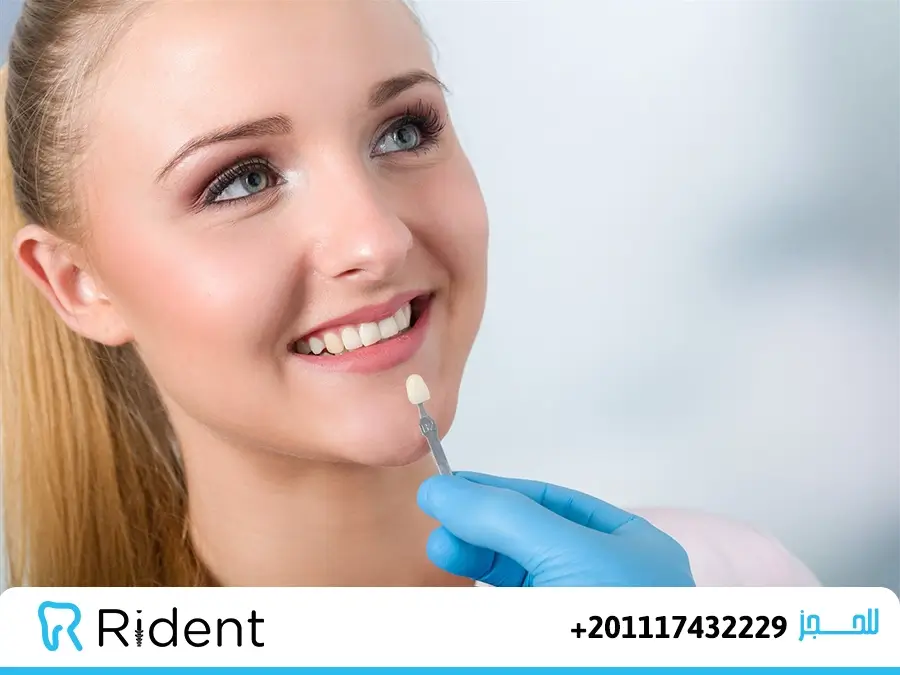 عيوب الفينير المحتملة و6 مميزات له