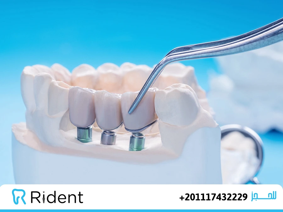 فوائد زراعة الاسنان واضرارها 1 فوائد زراعة الاسنان واضرارها