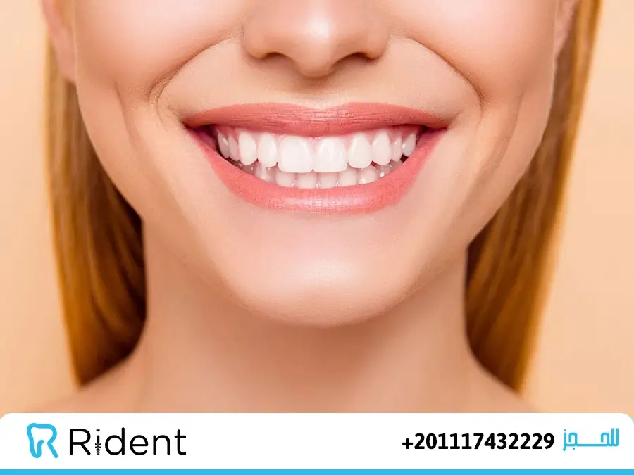 فينيرز الأسنان