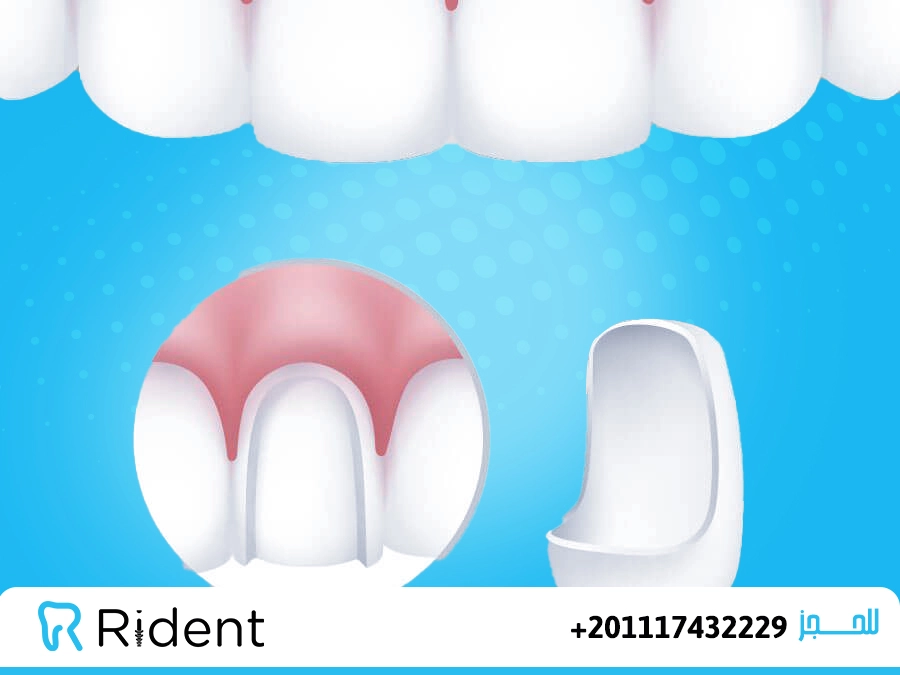 فينير الاسنان