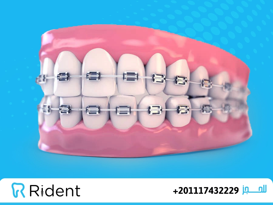 كم مدة تقويم الاسنان الامامية