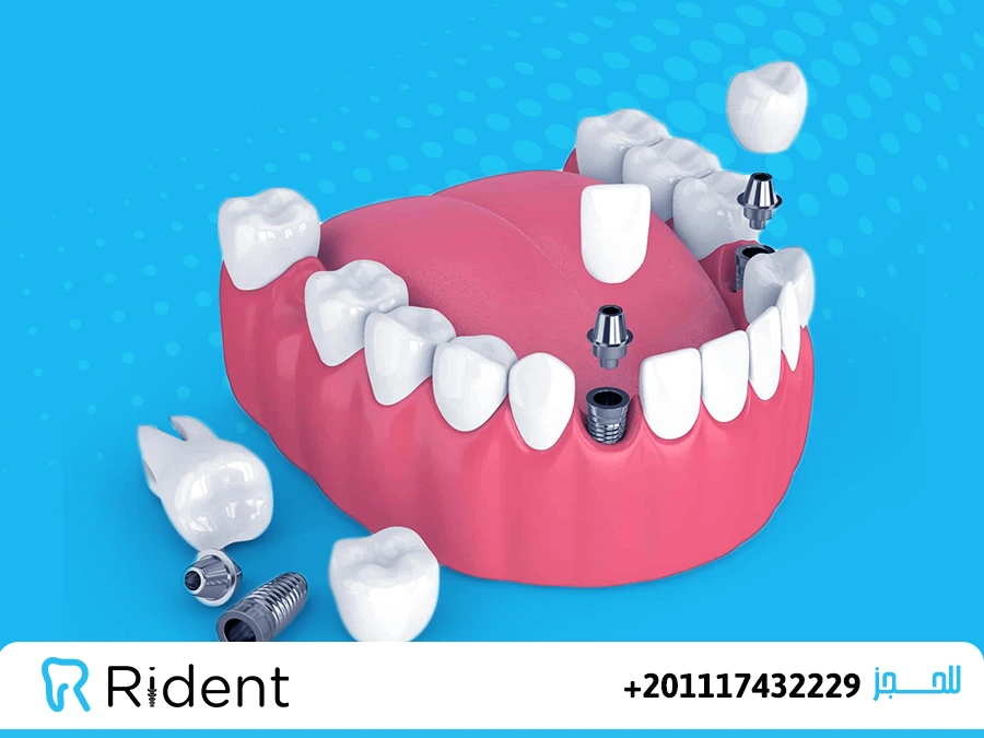 كم مدة زراعة الاسنان؟ 1 مدة زراعة الاسنان
