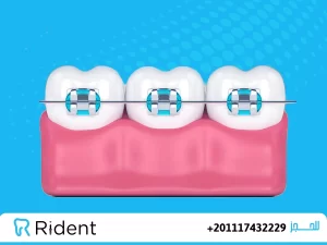 كيف يتم شد تقويم الاسنان