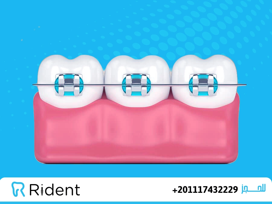 كيف يتم شد تقويم الاسنان
