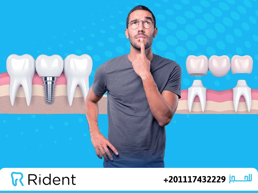 ما هو الفرق بين تركيب وزراعة الاسنان