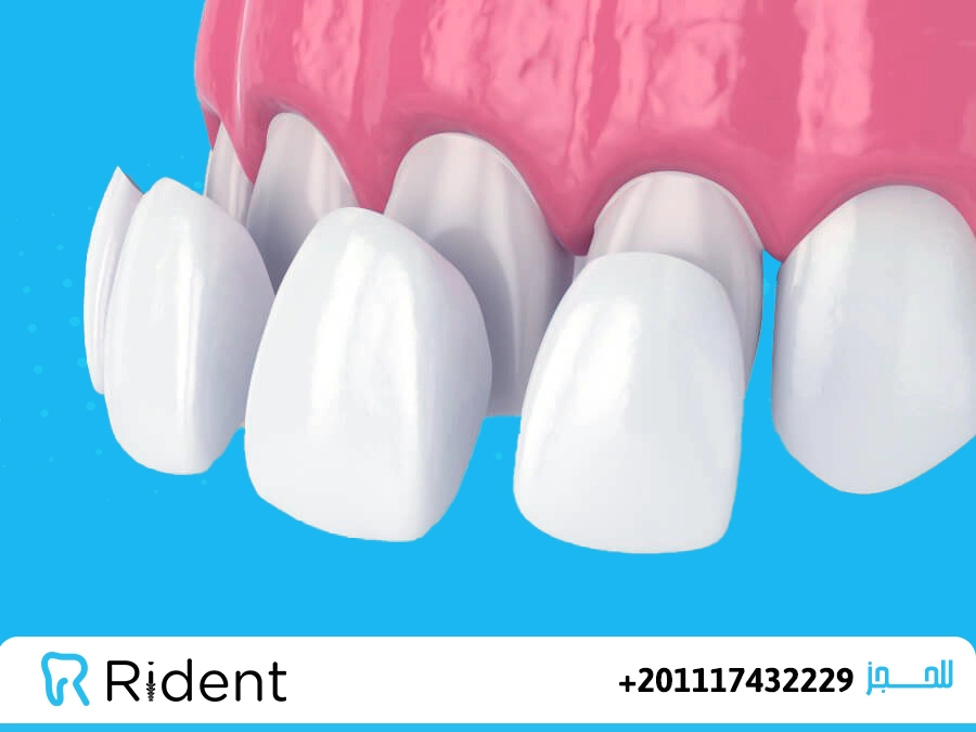 ما هو الفينير