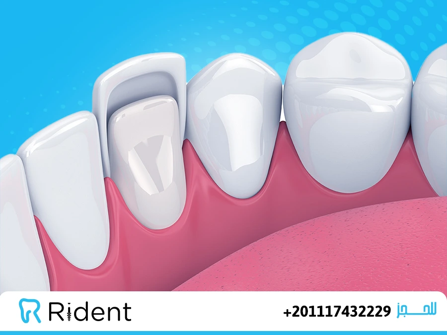 ما هي عدسات الأسنان 1 ما هي عدسات الأسنان 1