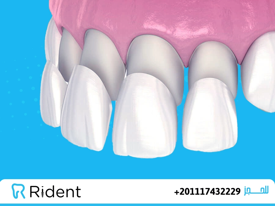 ما هي عدسات الأسنان