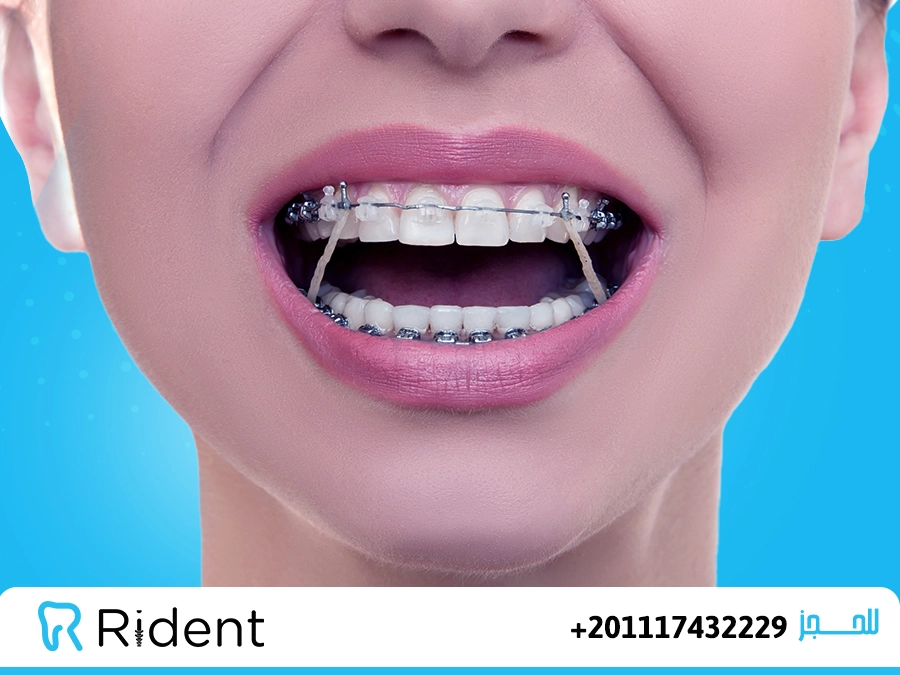 متى تبدأ الأسنان تتحرك بعد التقويم