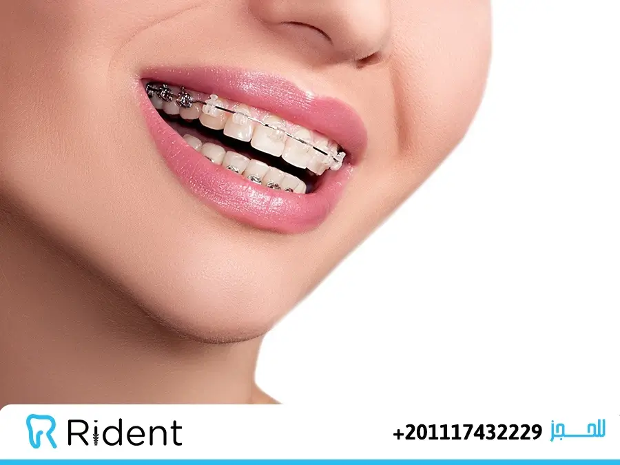 مدة تقويم الأسنان البارزة