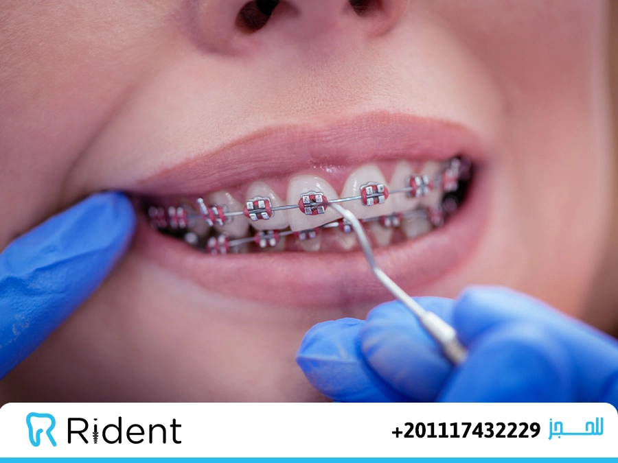 سعر تقويم الأسنان في السعودية 2024 1 مدة تقويم الاسنان