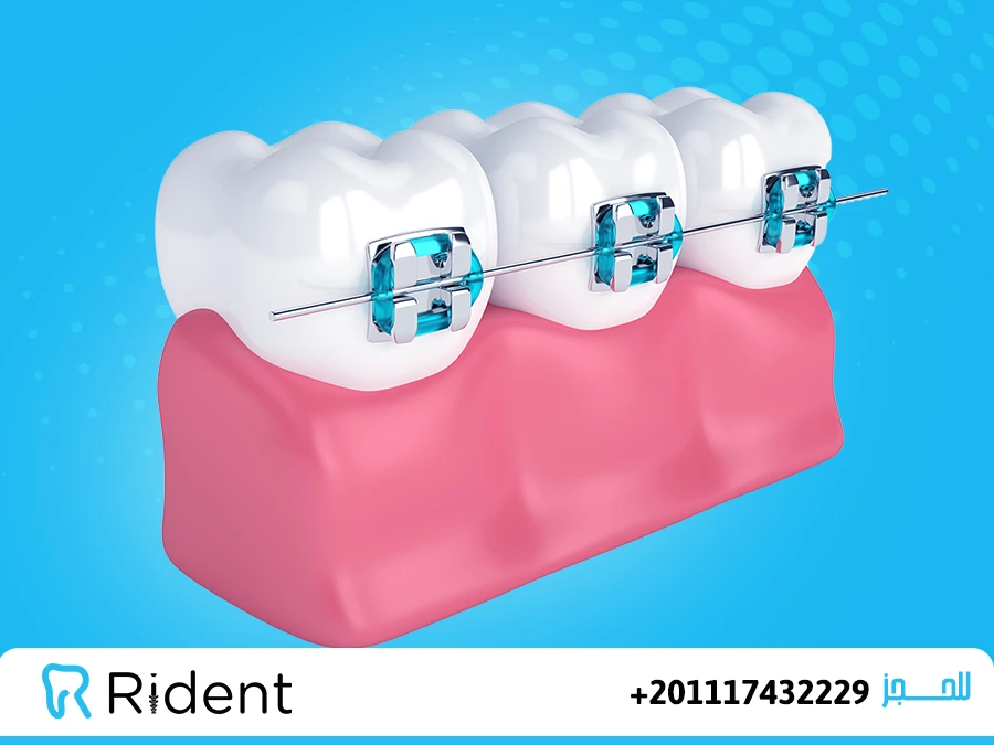 مدة تقويم الاسنان 1 مدة تقويم الاسنان2