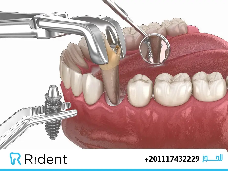 هل يمكن زراعة الاسنان بعد الخلع مباشرة أم بعد 4 أسابيع؟ 1 مدة زراعة الأسنان بعد الخلع