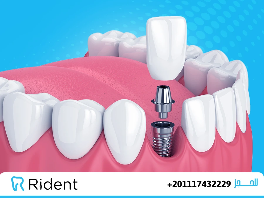 مراحل زراعة الاسنان2