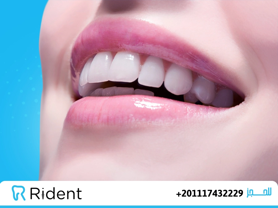 نصائح قبل تركيب هوليود سمايل