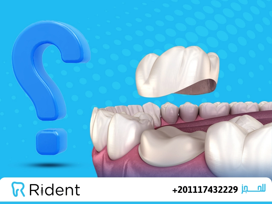 نظام الاكل بعد تركيب الطربوش
