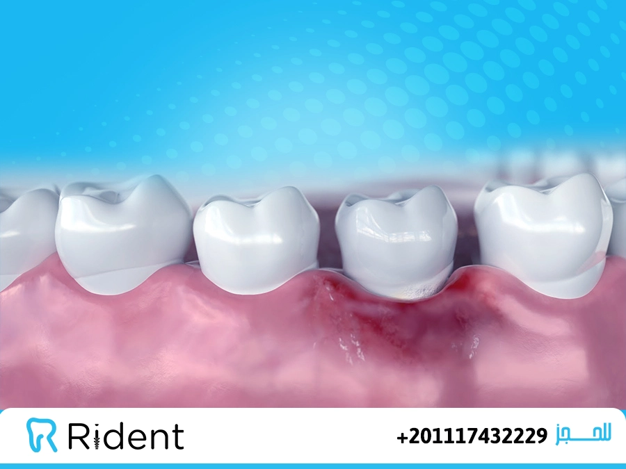 هل التهاب اللثة يسبب ألم الأسنان؟ 1 التهاب اللثة و احمرارها