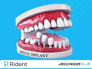 فيديوهات 9 هل زراعة الاسنان مؤلمة2