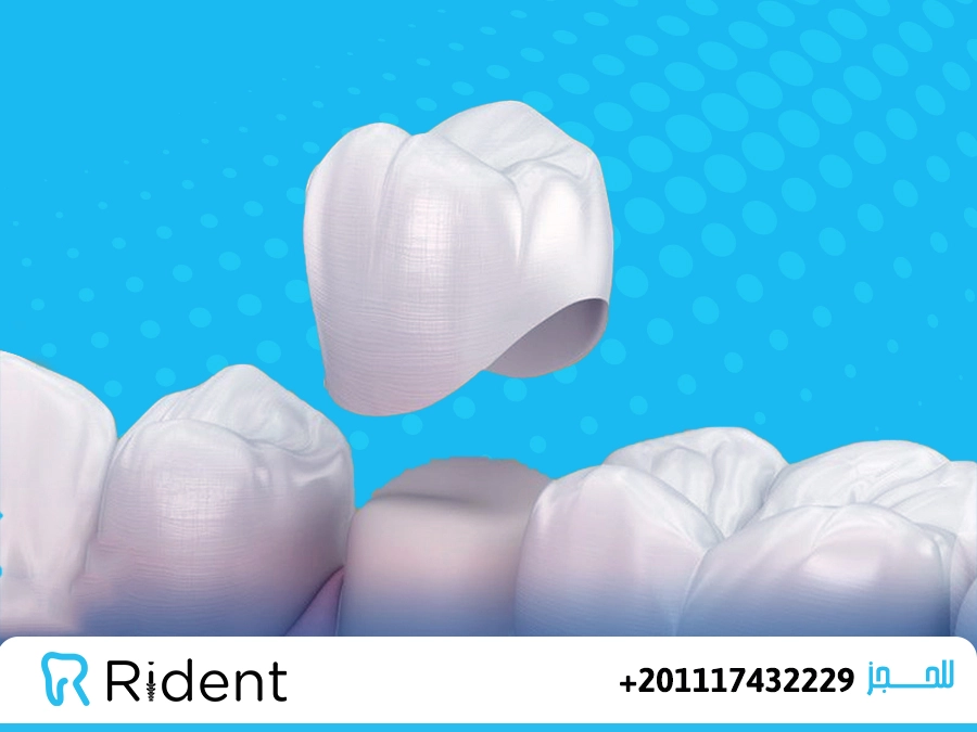 هل طربوش الأسنان دائم