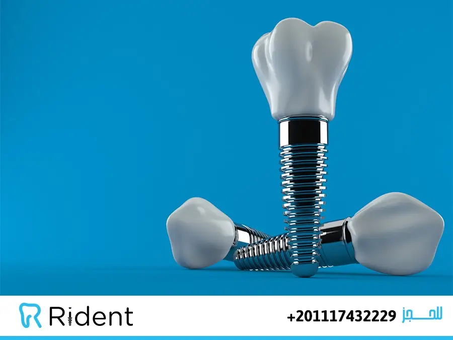 زراعة الاسنان بعد الخلع مباشرة